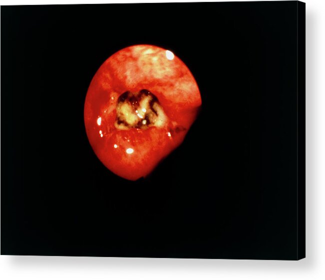 Ulcer Acrylic Print featuring the photograph Endoscope Image Of Bleeding Gastric Ulcer by Cnri/science Photo Library