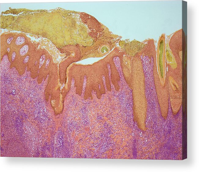 Abnormal Acrylic Print featuring the photograph Ringworm by Steve Gschmeissner