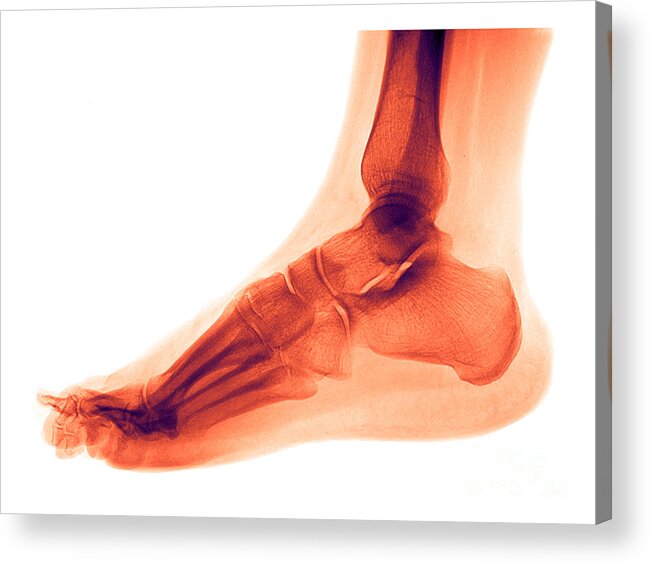 Anatomy Acrylic Print featuring the photograph Foot #3 by Medical Body Scans