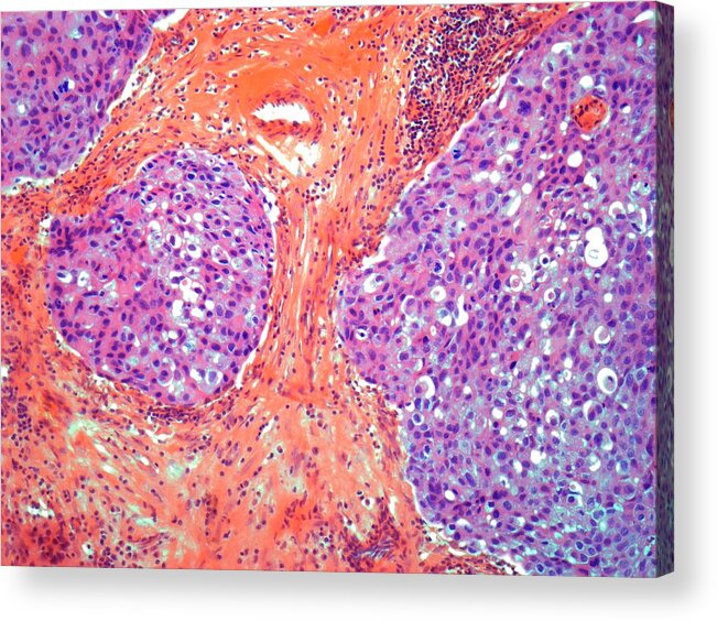 Anatomy Acrylic Print featuring the digital art Breast Cancer, Light Micrograph #1 by Steve Gschmeissner