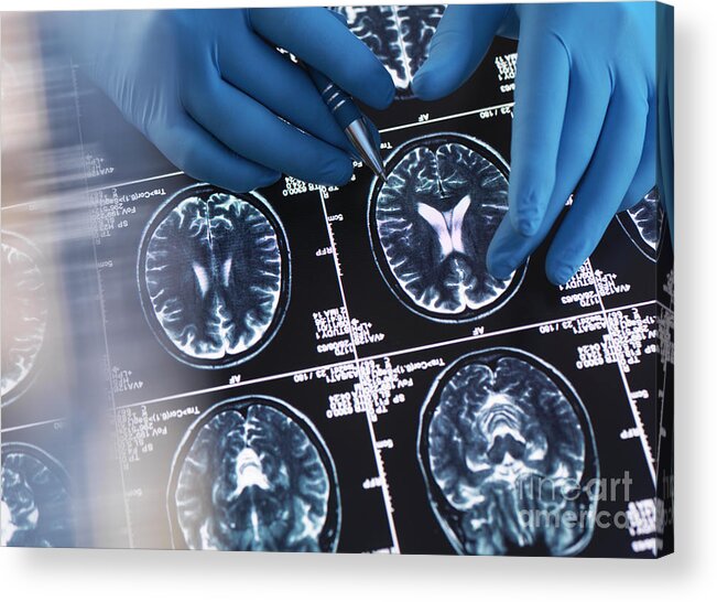 Dementia Acrylic Print featuring the photograph Neurology Diagnosis #18 by Tek Image/science Photo Library