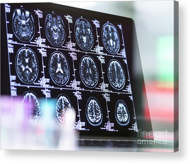 Dementia Acrylic Print featuring the photograph Neurology Diagnosis #8 by Tek Image/science Photo Library