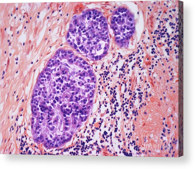 Condition Acrylic Print featuring the photograph Chronic Pancreatitis by Steve Gschmeissner/science Photo Library