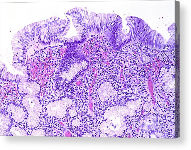 Anatomy Acrylic Print featuring the photograph Gastritis, light micrograph #1 by Science Photo Library