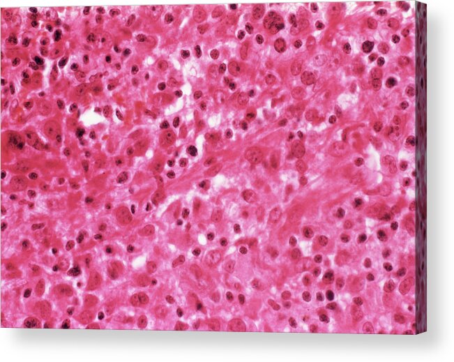 Mesothelioma Acrylic Print featuring the photograph Lung Cancer #2 by Cnri/science Photo Library