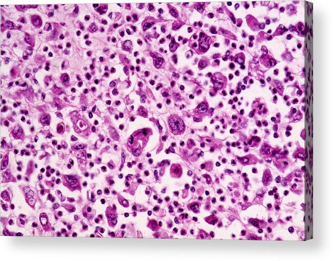 Abnormal Acrylic Print featuring the photograph Giant-cell Carcinoma Of The Lung, Lm by Michael Abbey