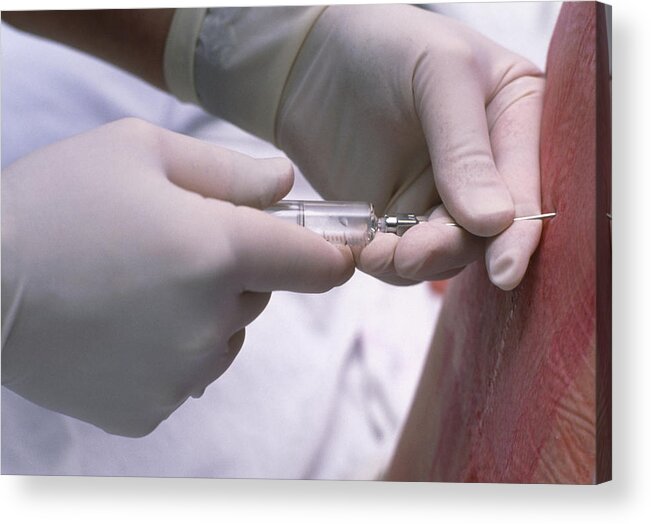 Epidural Anaesthesia Acrylic Print featuring the photograph Doctor Administering An Epidural Anaesthetic by David Nunuk