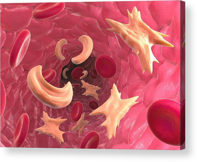 Abnormal Acrylic Print featuring the photograph Sickle Cell Anaemia, Artwork by David Mack