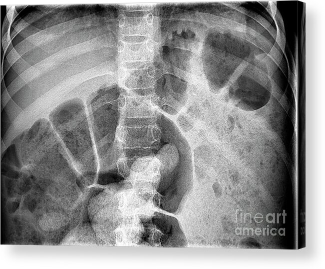Abnormal Acrylic Print featuring the photograph Bowel Obstruction #1 by Science Photo Library