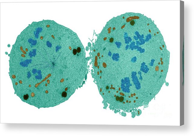 Condition Acrylic Print featuring the photograph Cancer Cell Division #3 by Steve Gschmeissner/science Photo Library