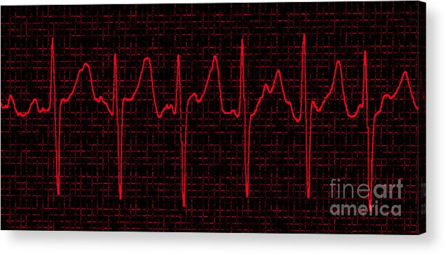 Atrial Fibrillation Acrylic Print featuring the photograph Atrial Fibrillation #3 by Science Source