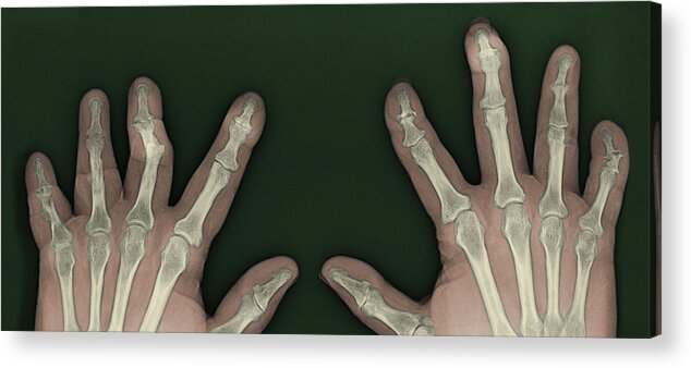 Abnormal Acrylic Print featuring the photograph Psoriatic Arthritis, X-ray by Steven Needell