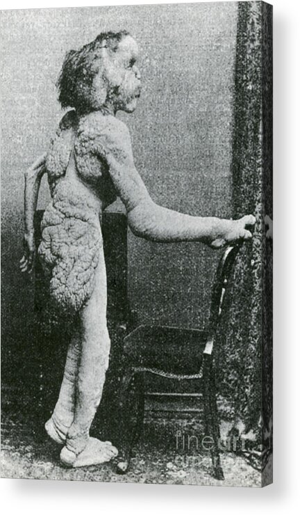 Science Acrylic Print featuring the photograph Joseph Merrick, The Elephant Man #2 by Science Source