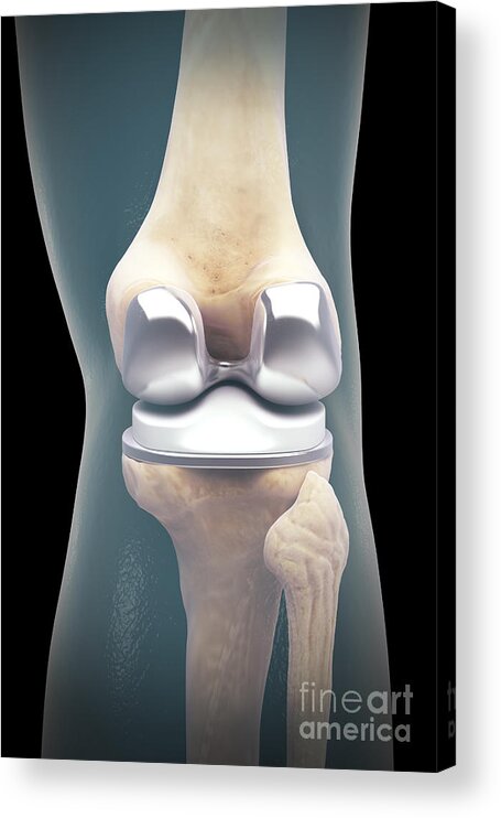 Digitally Generated Image Acrylic Print featuring the photograph Knee Replacement #3 by Science Picture Co
