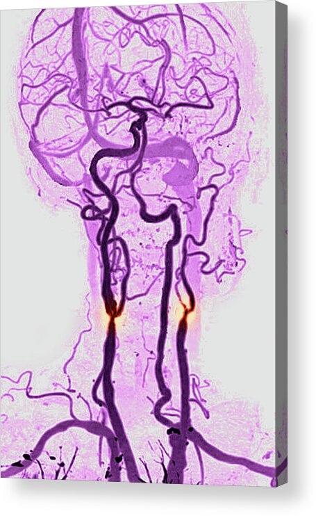 Artery Acrylic Print featuring the photograph Carotid Stenosis #3 by James Cavallini