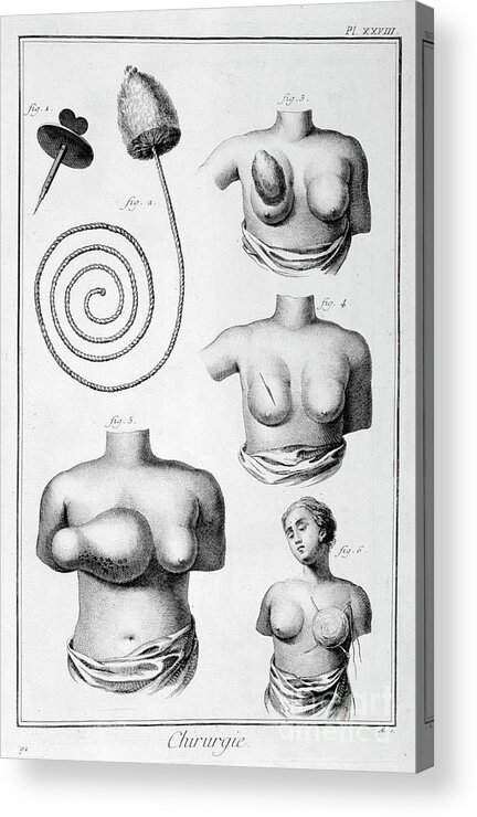 Engraving Acrylic Print featuring the drawing Breast Surgery, 1751-1777 by Print Collector