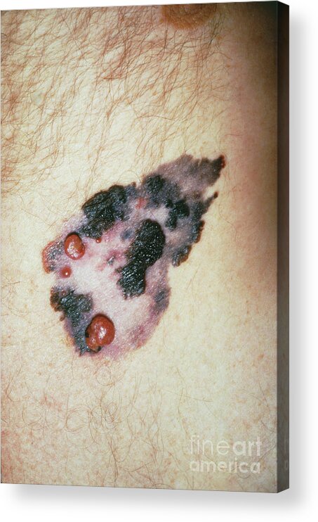 Melanoma Acrylic Print featuring the photograph Malignant Melanoma Of Chest Wall Of A Male by Kings College School Of Medicine, Department Of Surgery/science Photo Library