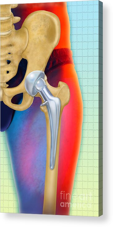 Science Acrylic Print featuring the photograph Prosthetic Hip Replacement by Chris Bjornberg