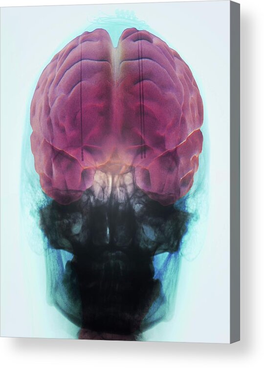 Coloured Acrylic Print featuring the photograph Brain Implants For Parkinson's Disease by Zephyr/science Photo Library