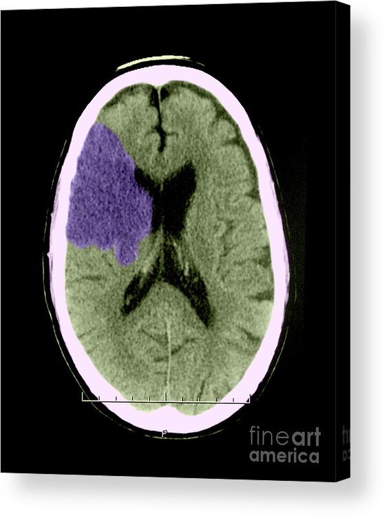 Ct Scan Acrylic Print featuring the photograph Ct Of Stroke by Medical Body Scans