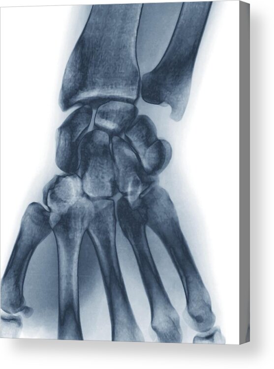 White Background Acrylic Print featuring the photograph Normal Wrist, X-ray by Zephyr