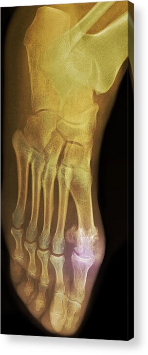 Coloured X-ray Acrylic Print featuring the photograph 'gouty Foot, X-ray' #1 by Du Cane Medical Imaging Ltd