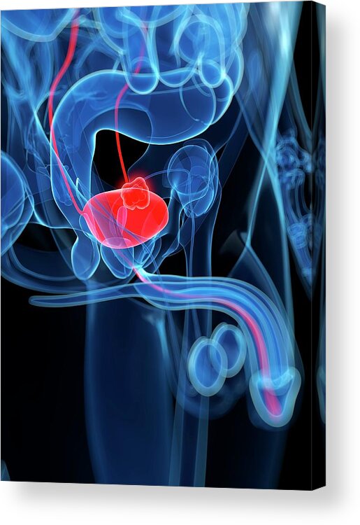 Bladder Cancer Acrylic Print featuring the digital art Bladder Cancer, Artwork by Sciepro