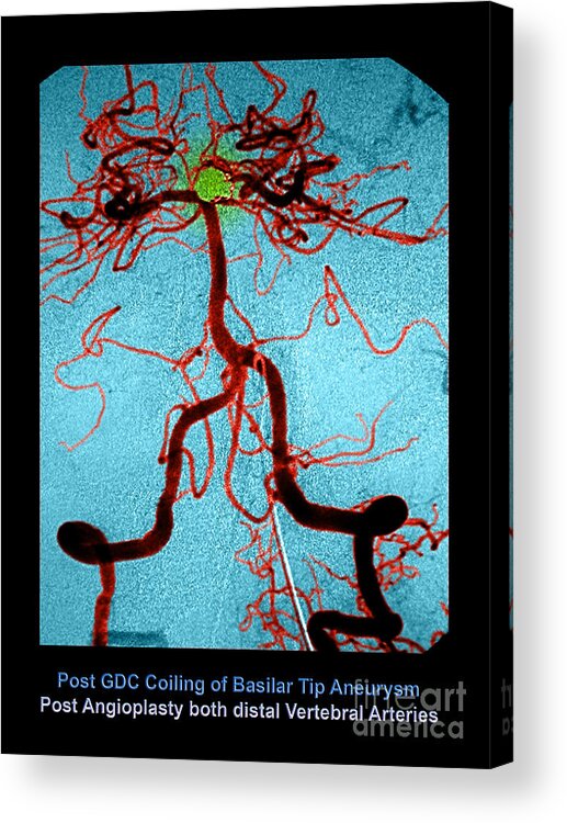 Abnormal Blood Vessel Acrylic Print featuring the photograph Cerebral Angiogram #2 by Medical Body Scans