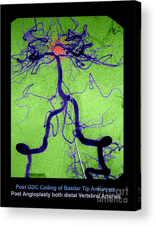 Abnormal Blood Vessel Acrylic Print featuring the photograph Cerebral Angiogram by Medical Body Scans