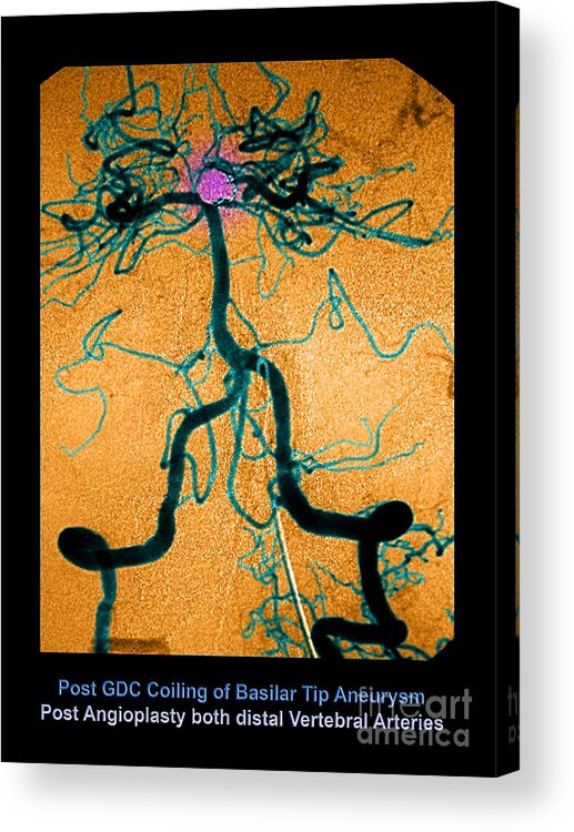Abnormal Blood Vessel Acrylic Print featuring the photograph Cerebral Angiogram #6 by Medical Body Scans