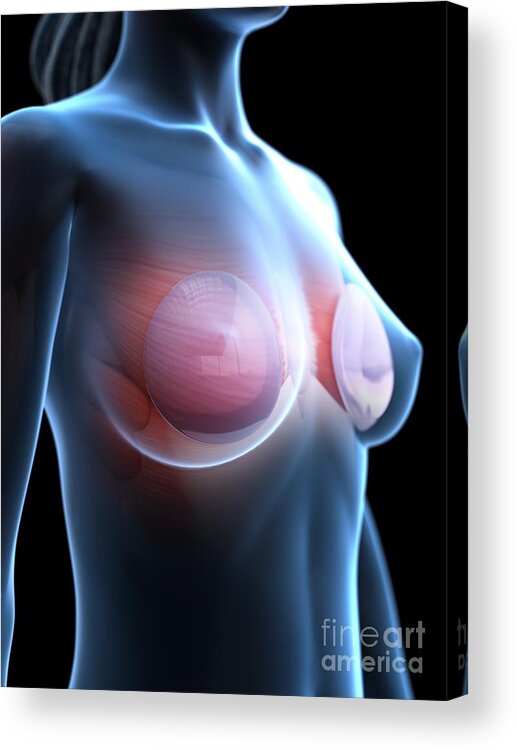 3d Acrylic Print featuring the photograph Breast Implants #10 by Sebastian Kaulitzki/science Photo Library