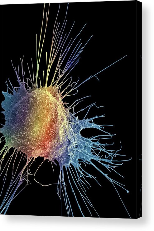 Abnormal Acrylic Print featuring the photograph Prostate Cancer Cell #3 by Steve Gschmeissner