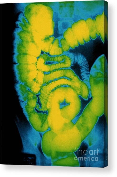 Barium X-ray Acrylic Print featuring the photograph X-ray Of Large Intestine by Susan Leavines