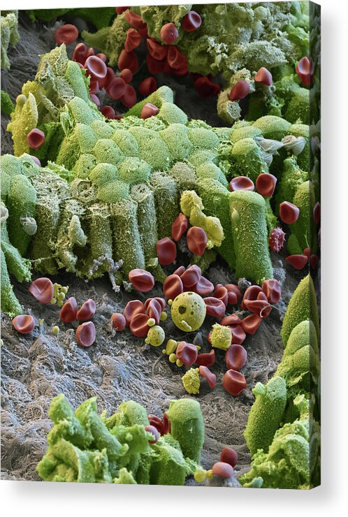 Abnormal Acrylic Print featuring the photograph Damaged Gallbladder, Sem #3 by Eye of Science
