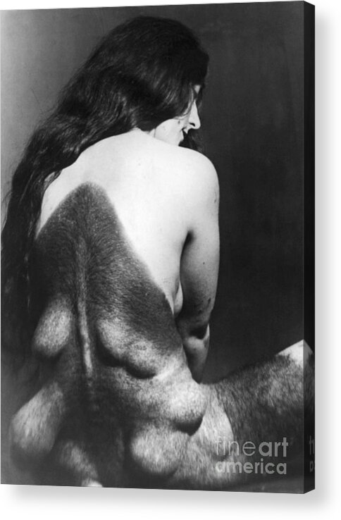 People Acrylic Print featuring the photograph Woman With Glandular Problem Female by Bettmann