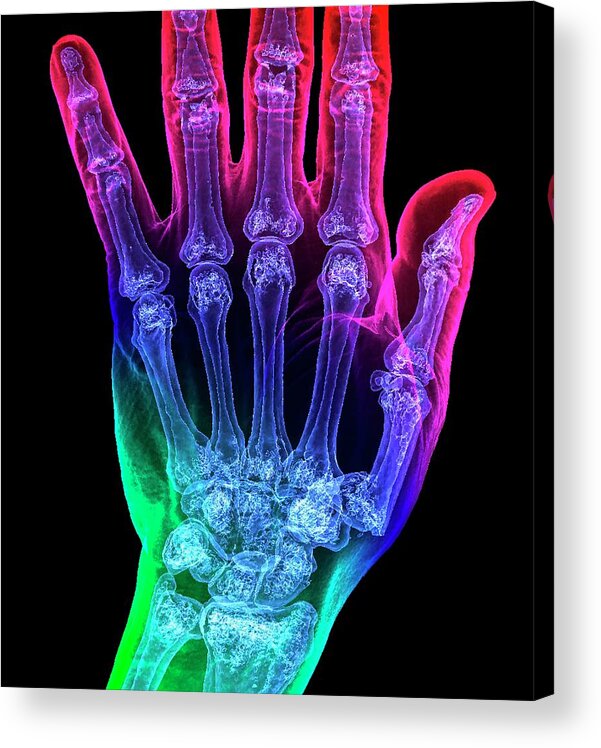Black Background Acrylic Print featuring the photograph Thumb Fracture by K H Fung/science Photo Library