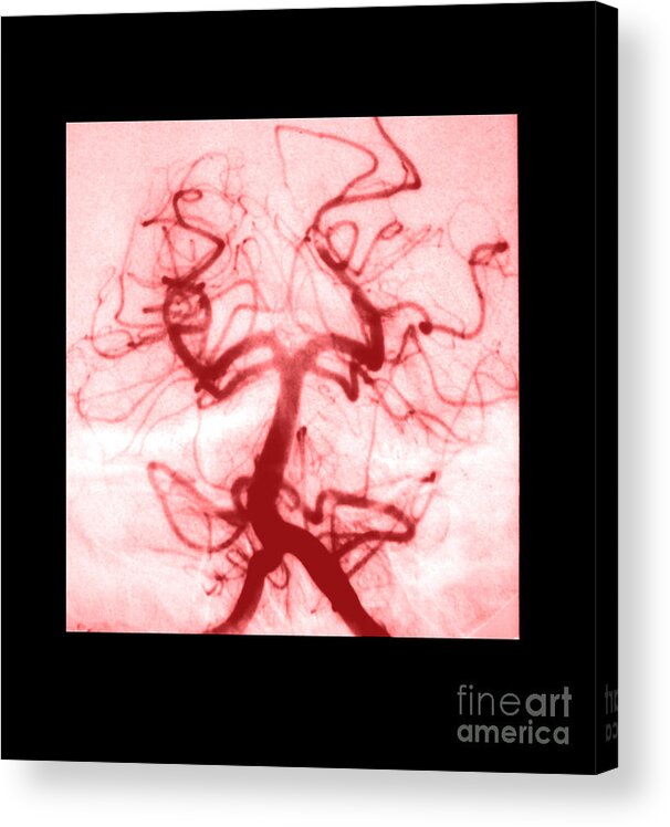 Abnormal Cerebral Angiogram Acrylic Print featuring the photograph Angiogram Of Embolus In Cerebral Artery by Medical Body Scans