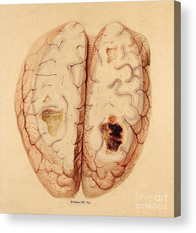 Historic Acrylic Print featuring the photograph Extravasated Blood, Brain by Wellcome Images