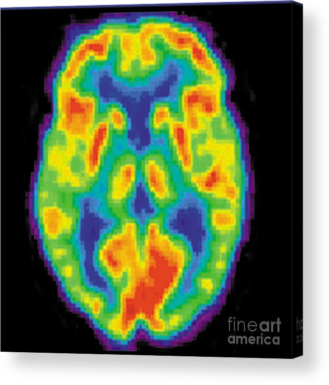 Diagnostic Acrylic Print featuring the photograph Pet Scan Of 20-year-old Brain by Science Source