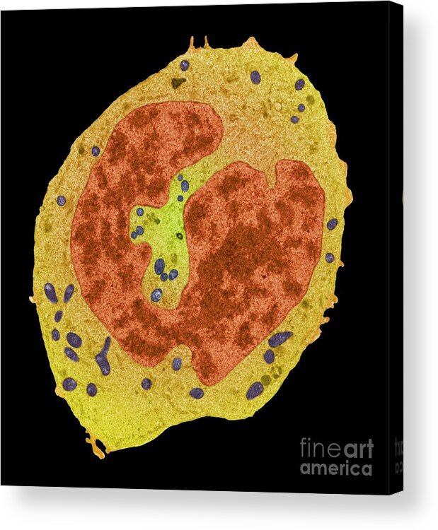 Condition Acrylic Print featuring the photograph Sarcoma Cancer Cell by Steve Gschmeissner/science Photo Library