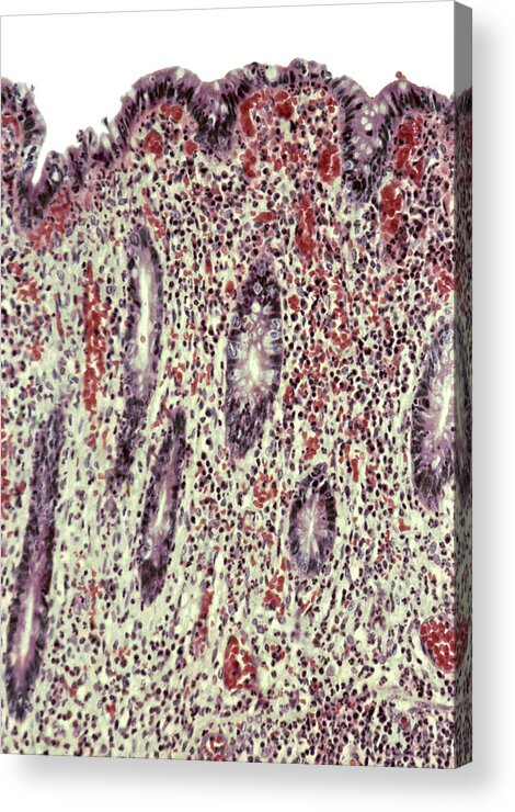 Appendicitis Acrylic Print featuring the photograph Appendicitis, Light Micrograph by Steve Gschmeissner
