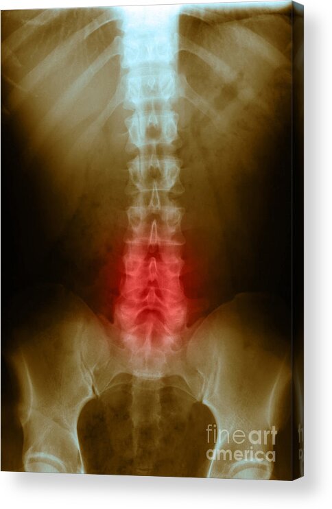 X Ray Acrylic Print featuring the photograph Compression In Lumbar Vertebrae #1 by Science Source