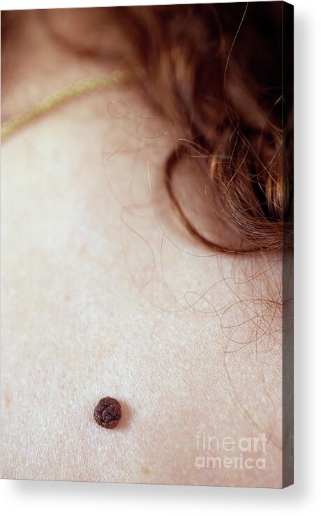 Melanotic Acrylic Print featuring the photograph Mole #1 by Lea Paterson/science Photo Library