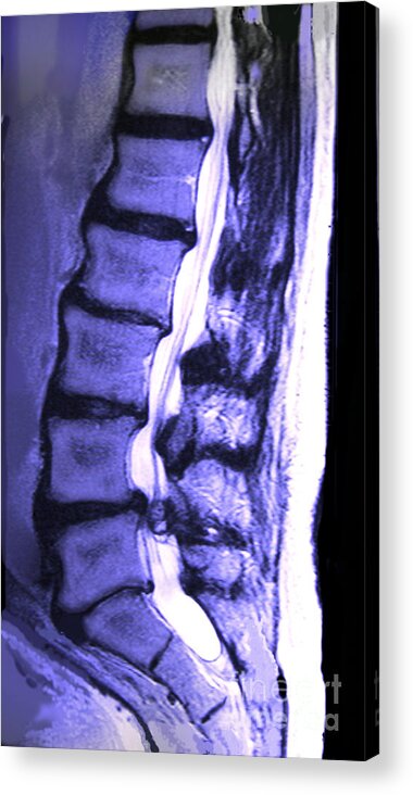 Arthritic Spine Acrylic Print featuring the photograph Arthritic Spine by Chris Bjornberg