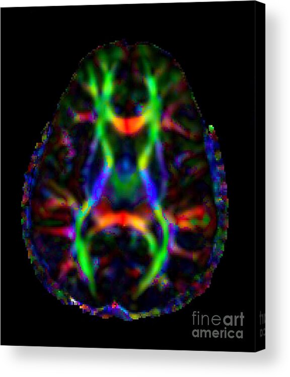 Science Acrylic Print featuring the photograph Normal Brain Diffusion Tractography #1 by Living Art Enterprises