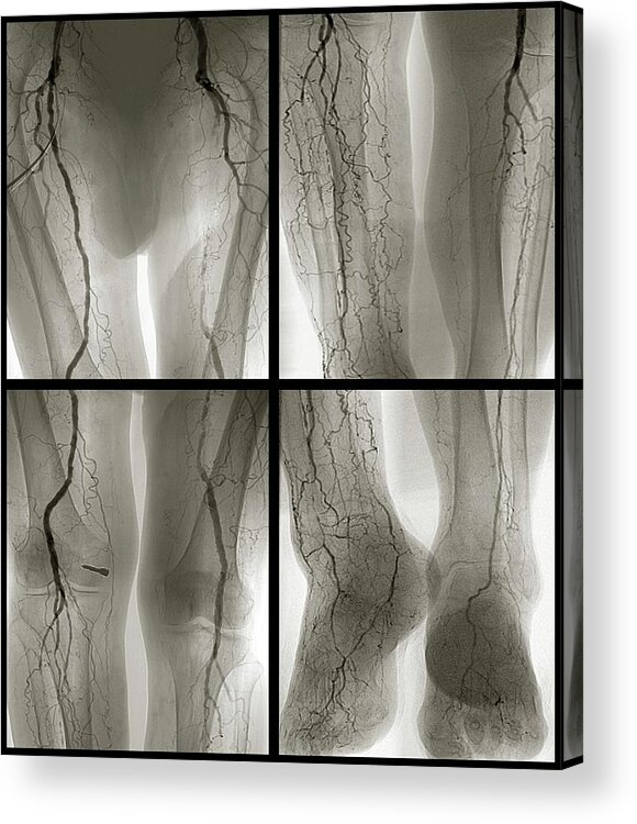Arteritis Acrylic Print featuring the photograph Arteritis by Zephyr/science Photo Library