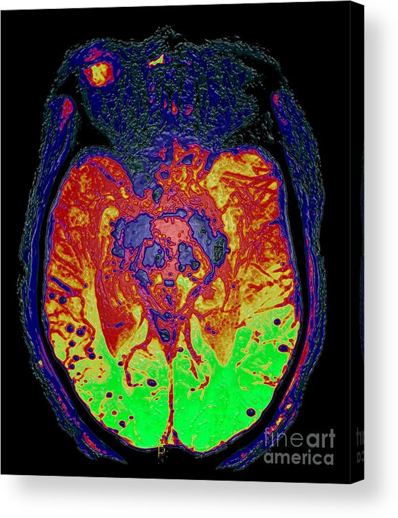 Mri Brain Acrylic Print featuring the photograph Intracerebral Hemorrhages, Mri by Living Art Enterprises