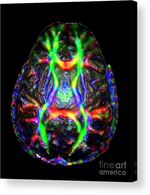 Science Acrylic Print featuring the photograph Normal Brain Diffusion Tractography by Living Art Enterprises