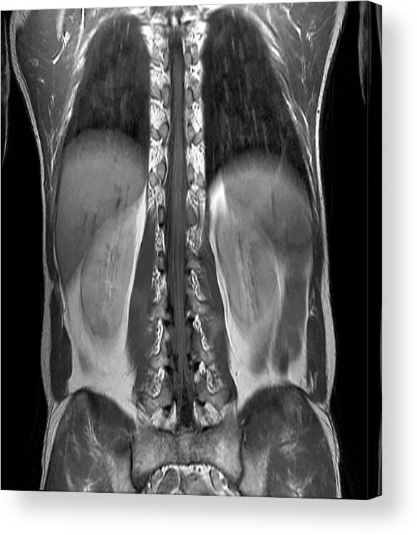 Black And White Acrylic Print featuring the photograph Normal Spinal Cord by Zephyr