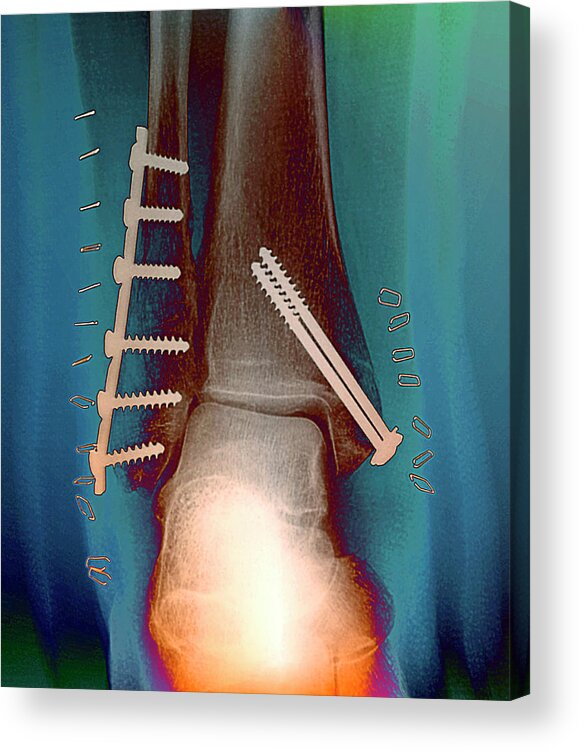 Break Acrylic Print featuring the photograph Pinned Ankle Fractures by Zephyr/science Photo Library